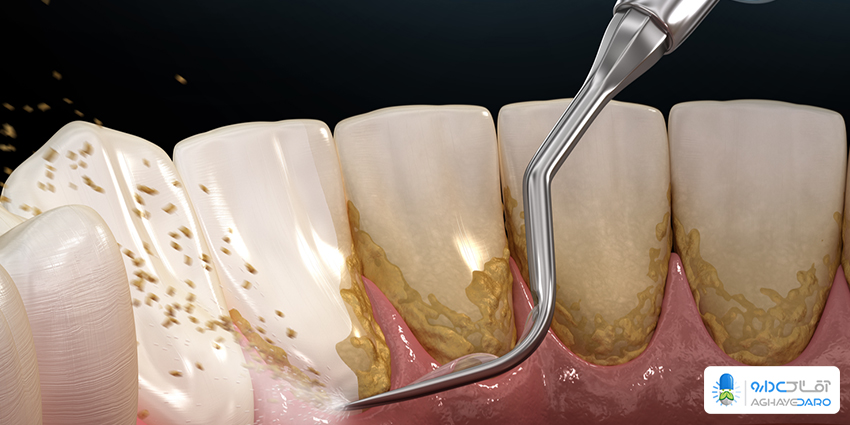 منظور از جرم گیری دندان چیست ؟